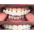 New Snap Smile Customized Label Upper False Teeth Cover Perfect Smile Veneers Comfort Fit Flex Denture Braces Teeth Whitening